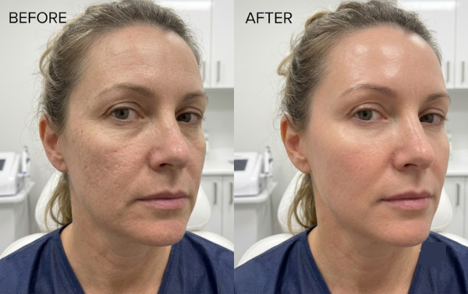 Microneedling Before and After Guide: Transforming Skin Texture and Appearance microneedling before and after